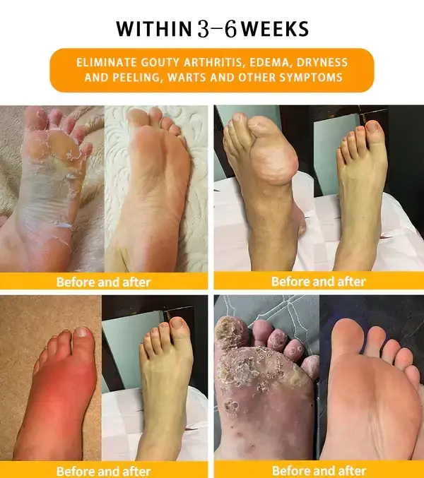 Bee Venom Lymphatic Drainage & Slimming Foot SoakBeads