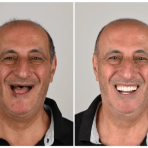 3D Dentures