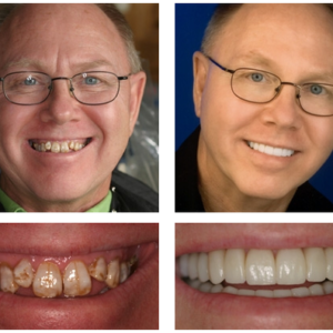 3D Dentures