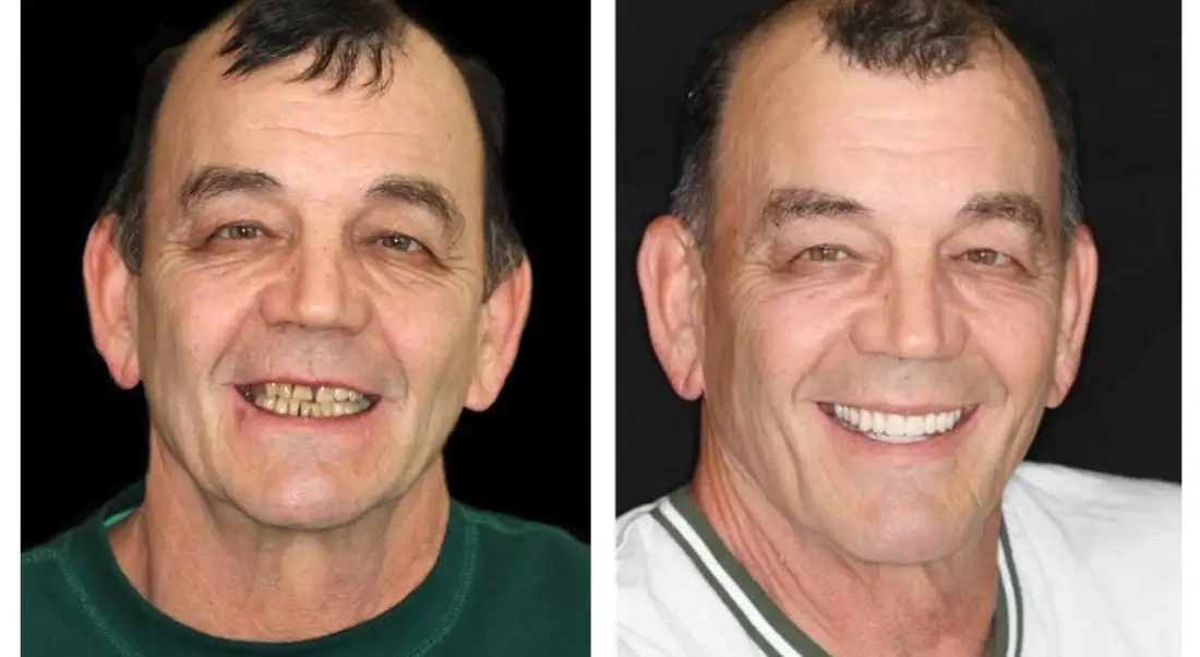 Advanced Customized Full Denture Set - Image 11