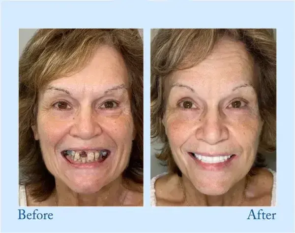 Advanced Customized Full Denture Set - Image 4