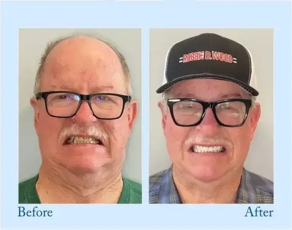 Advanced Customized Full Denture Set - Image 8