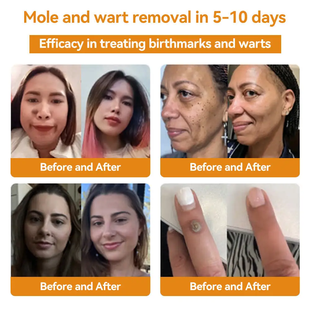 Bee Venom Wart & Moles Removal Cream - Image 3