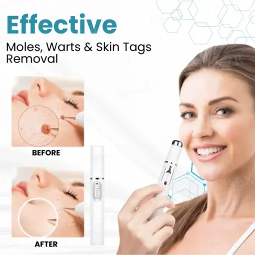 Non-Invasive Mole and Wart Removal Laser Pen - Image 5