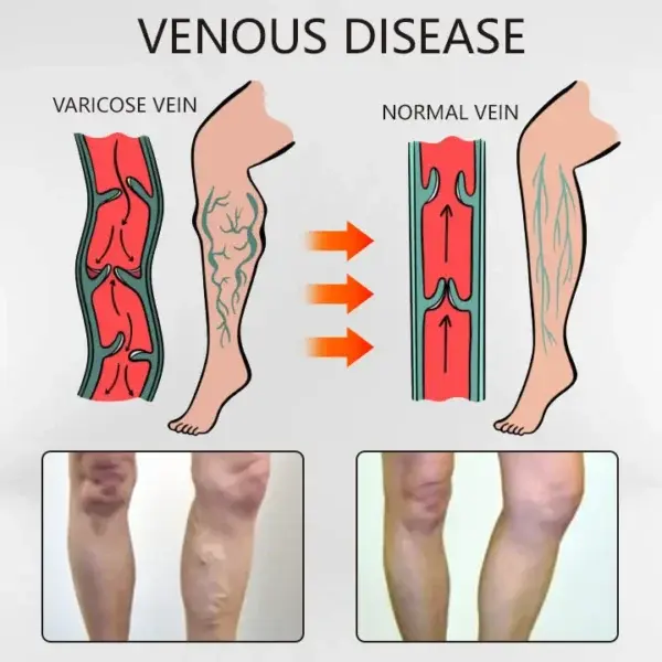 Varicose Veins Relief Oil - Image 3