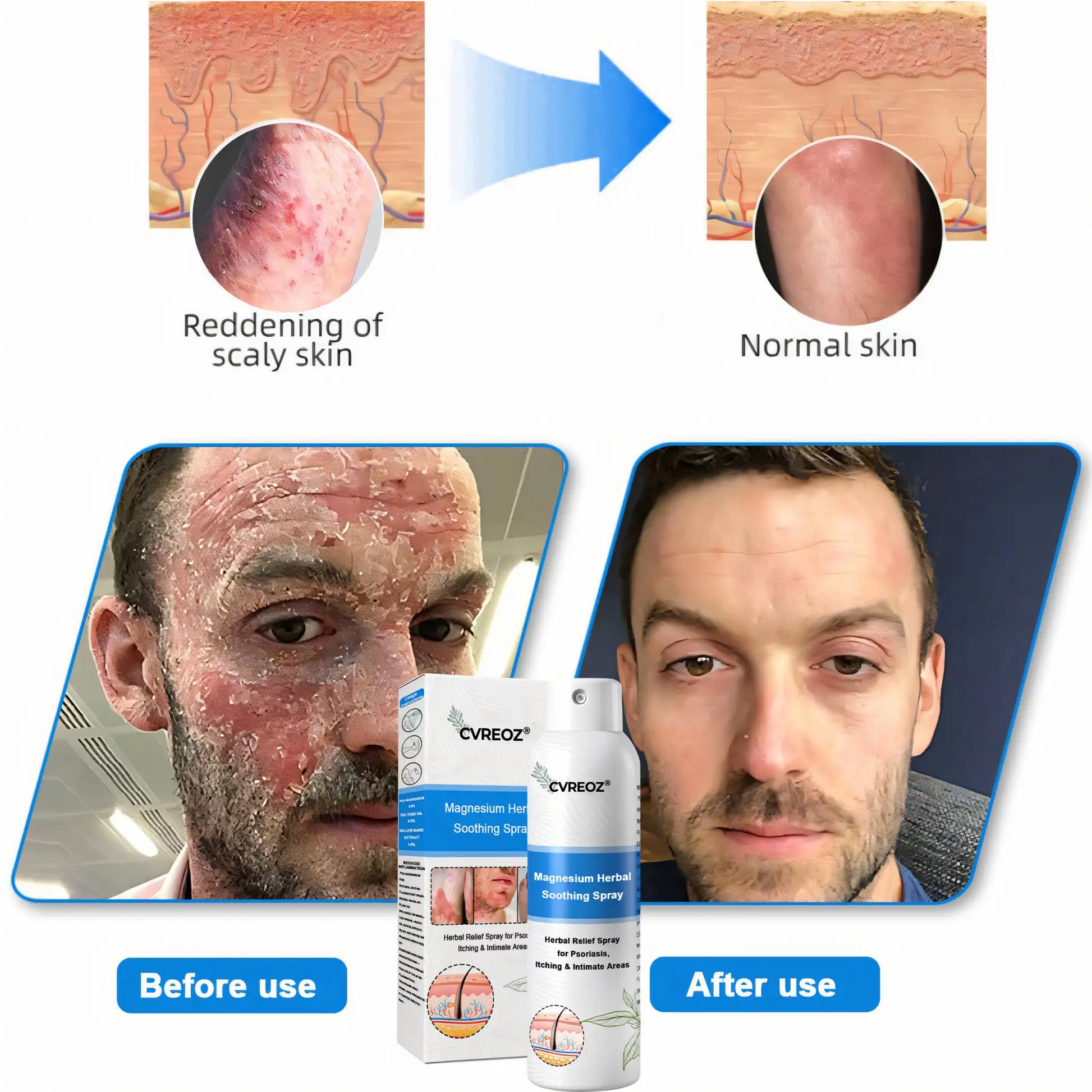 Magnesium Herbal Psoriasis Spray FDA Approved - Image 9