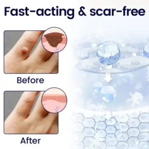 Alternative view of WartFreez Cryo Wart Removal Spray