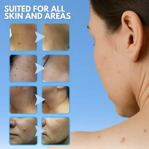 Skin Tag Removal Pen - Image 5