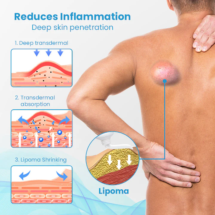 Lipoma Treatment Ointment - Image 2