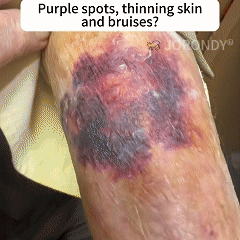 Bee Venom Senile Purpura Cream - Image 2