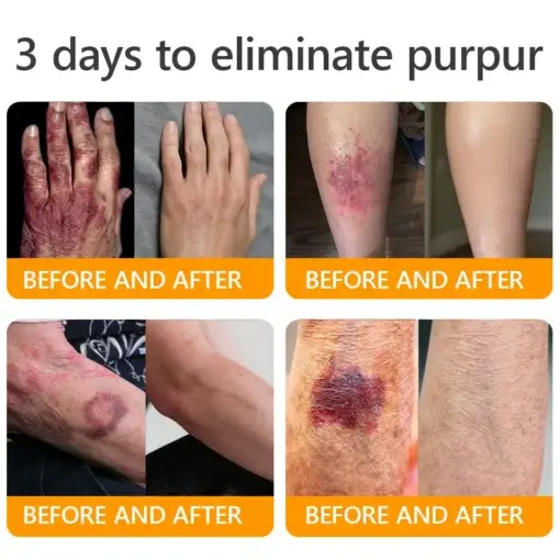 Bee Venom Senile Purpura Cream - Image 5