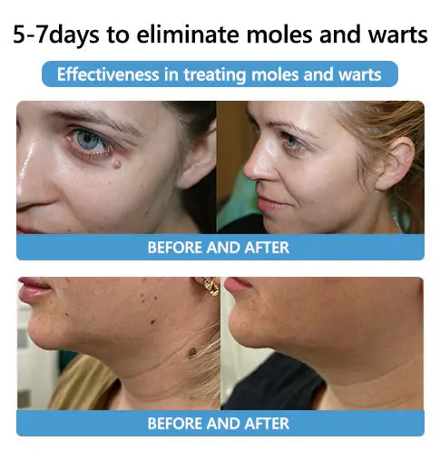 Bee Venom Mole and Wart Treatment Cream - Image 6