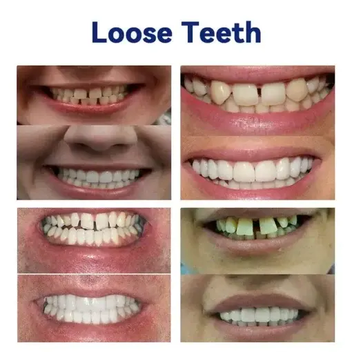 Advanced Customized Full Denture Set - Image 9