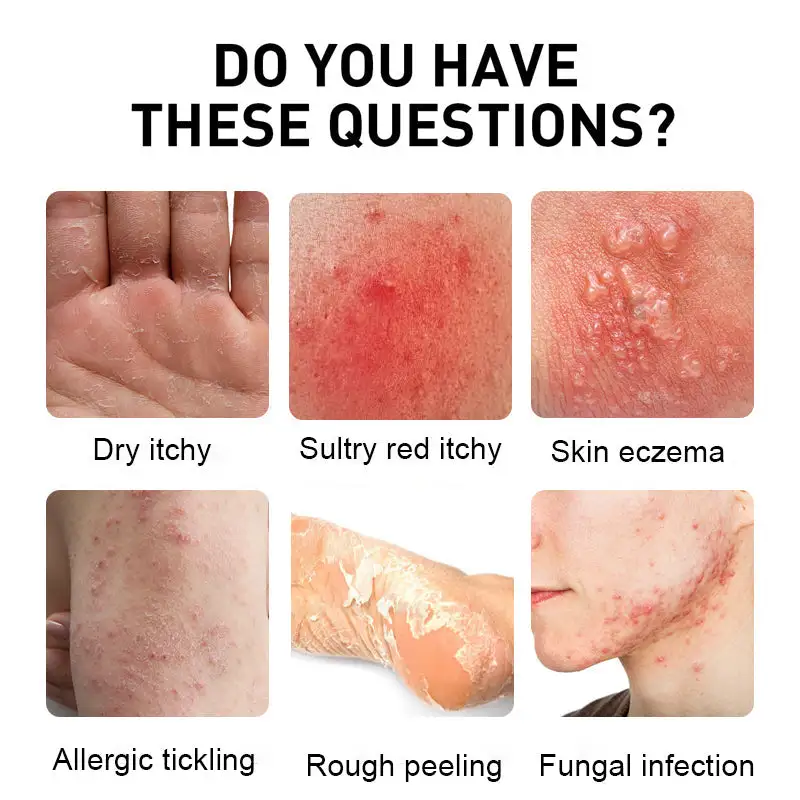 Psoriasis Cure Cream - Image 2