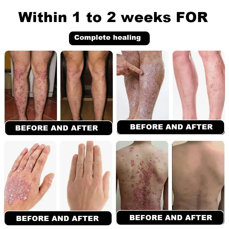 Psoriasis Cure Cream - Image 4