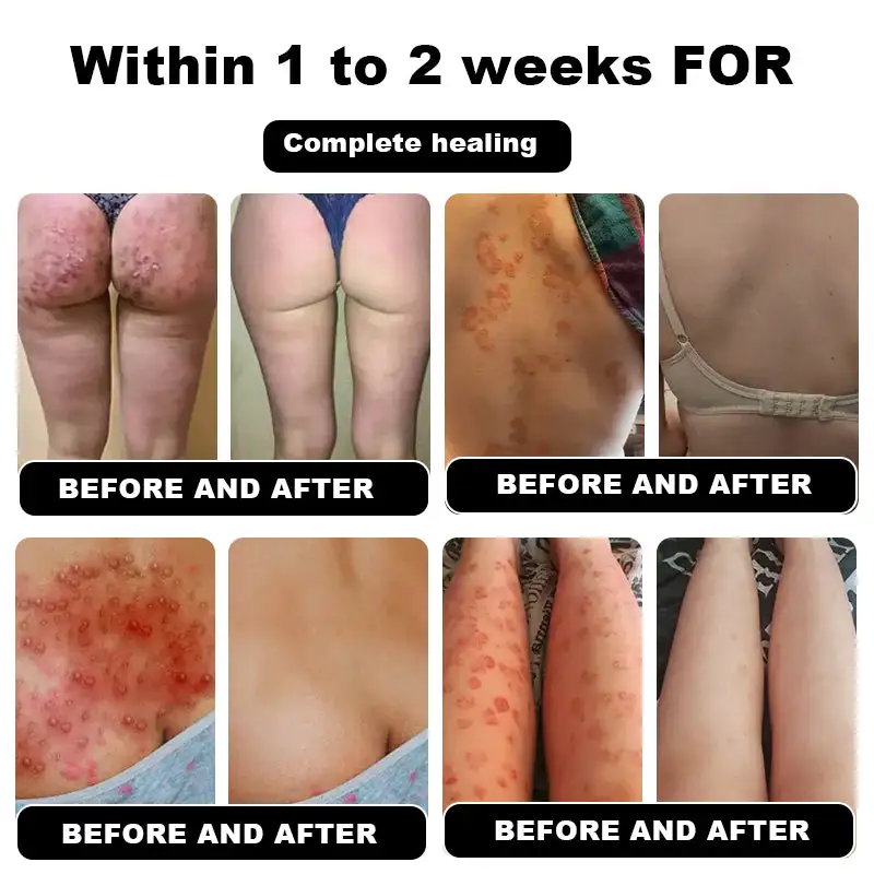 Psoriasis Cure Cream - Image 5