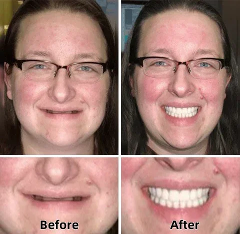 Custom Functional Denture Kits - Image 2