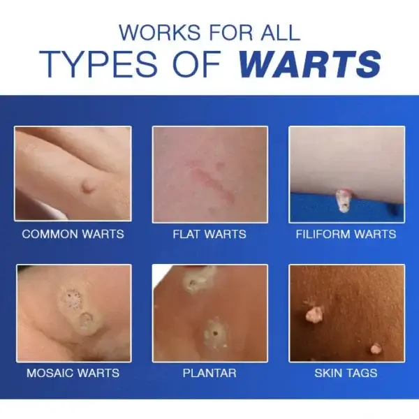 Wart Eraser Pro - Image 6