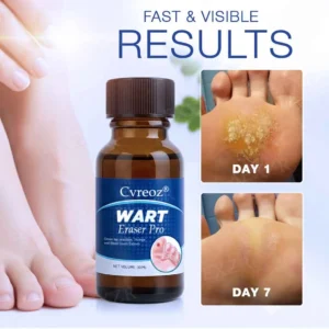 Alternative view of Wart Eraser Pro