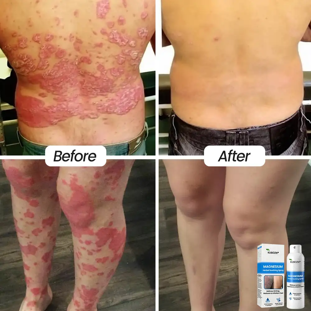 Magnesium Herbal Psoriasis Spray - Image 5