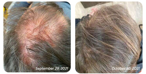 Scalp Folliculitis Therapy Oil - Image 6