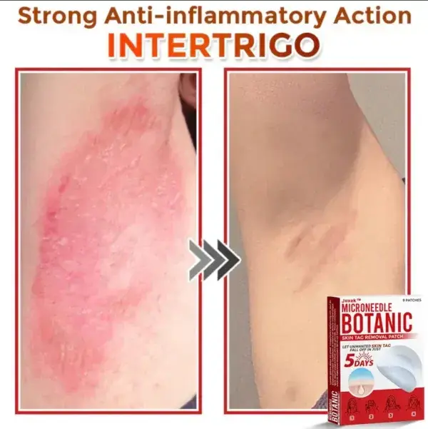Removal Patch: Gentle Microneedle Patches for Skin Tag & Mole Removal - Image 8