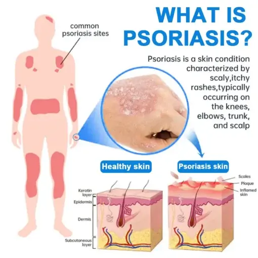 QIAWI Magnesium Herbal Psoriasis Spray - Image 3