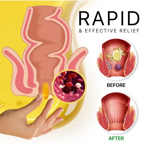 Bee-Venom Hemorrhoid Capsule - Image 5