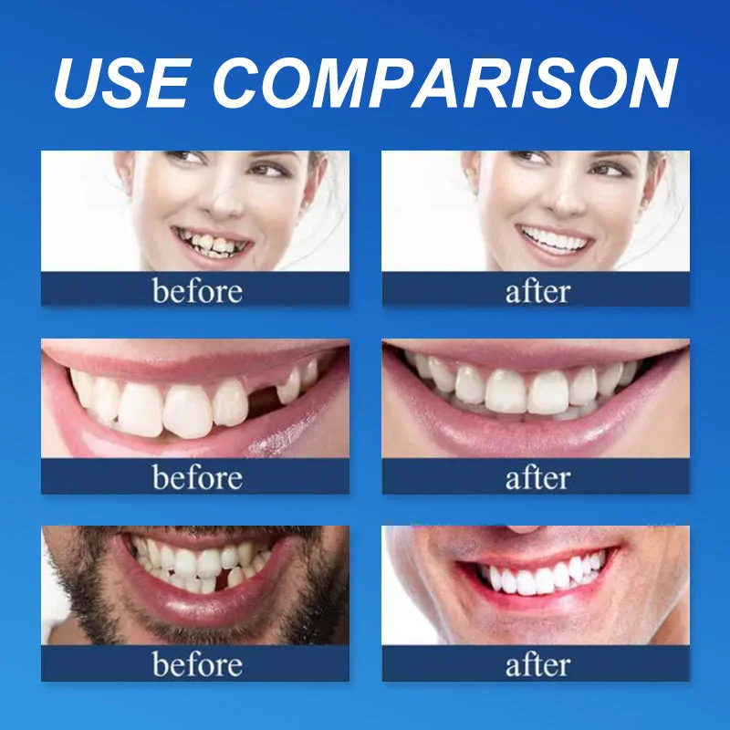 Premium Custom Complete Denture Set - Image 5