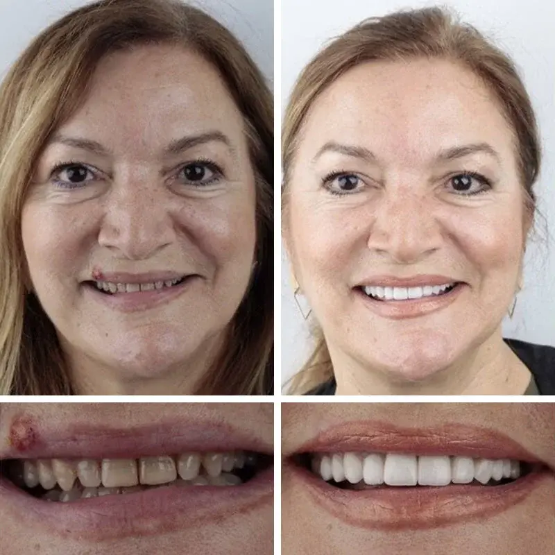 Advanced Customized Full Denture Set - Image 8