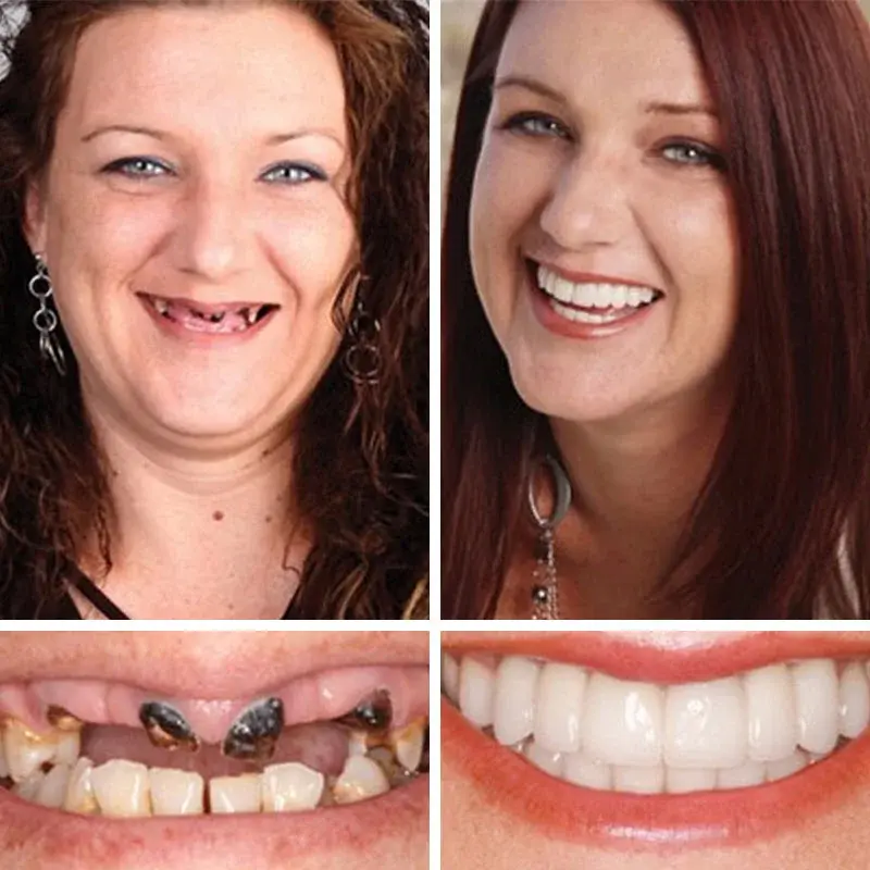 Advanced Customized Full Denture Set - Image 9