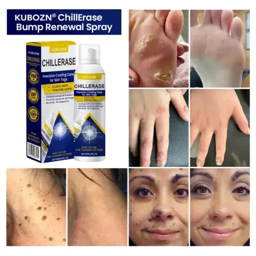ChillErase Cooling Spray for Skin Tags - Image 2