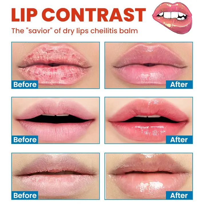 Cheilitis Cream - Image 12