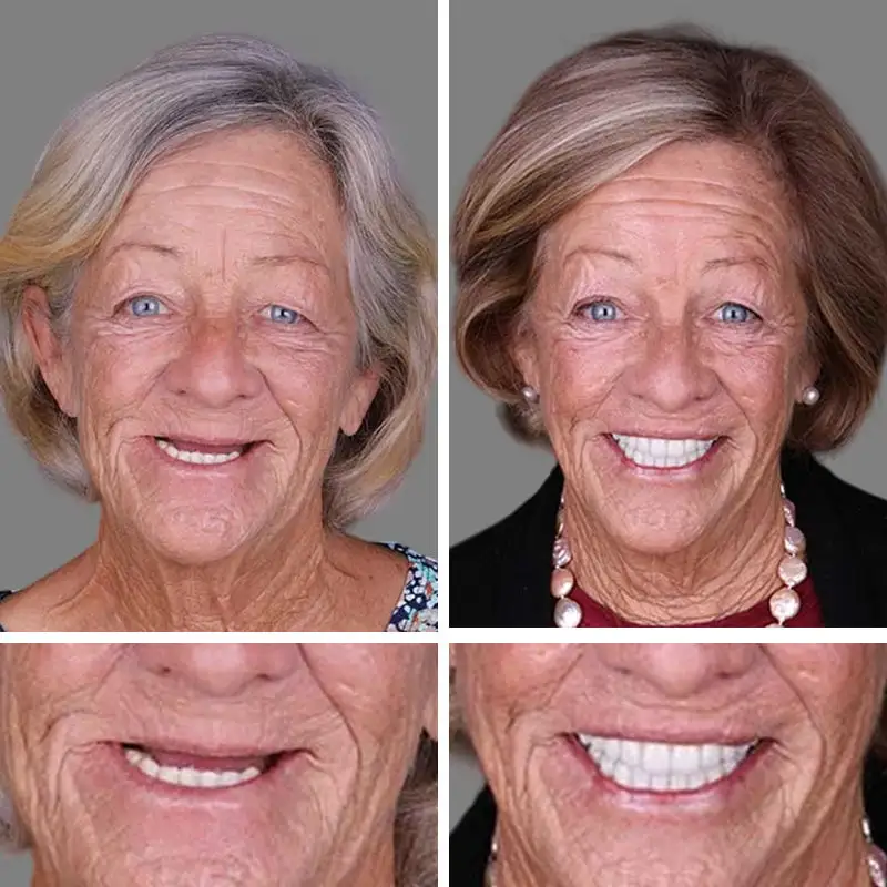 Advanced Customized Full Denture Set - Image 9
