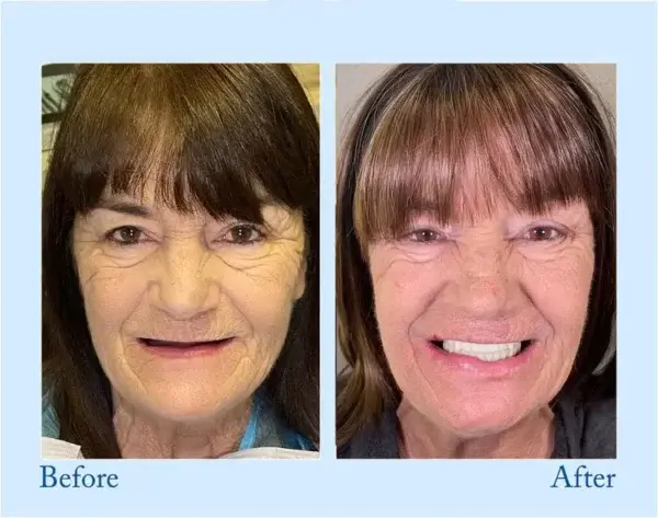 Custom-Fit Functional Dentures – Perfectly Fitted in Minutes at Home - Image 9