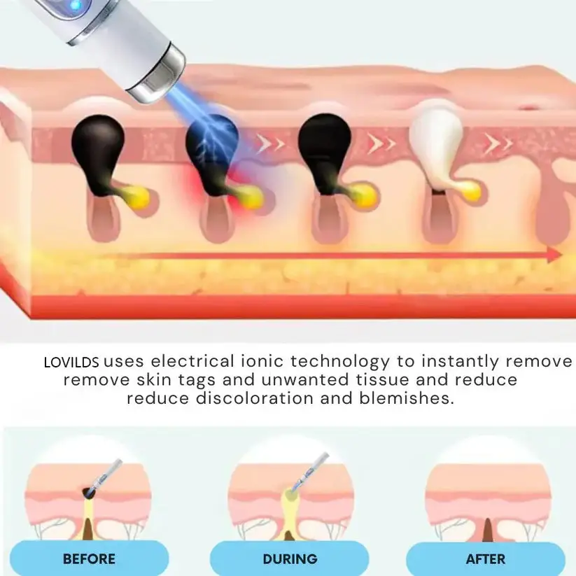 Non-Invasive Mole and Wart Removal Laser Pen - Image 2