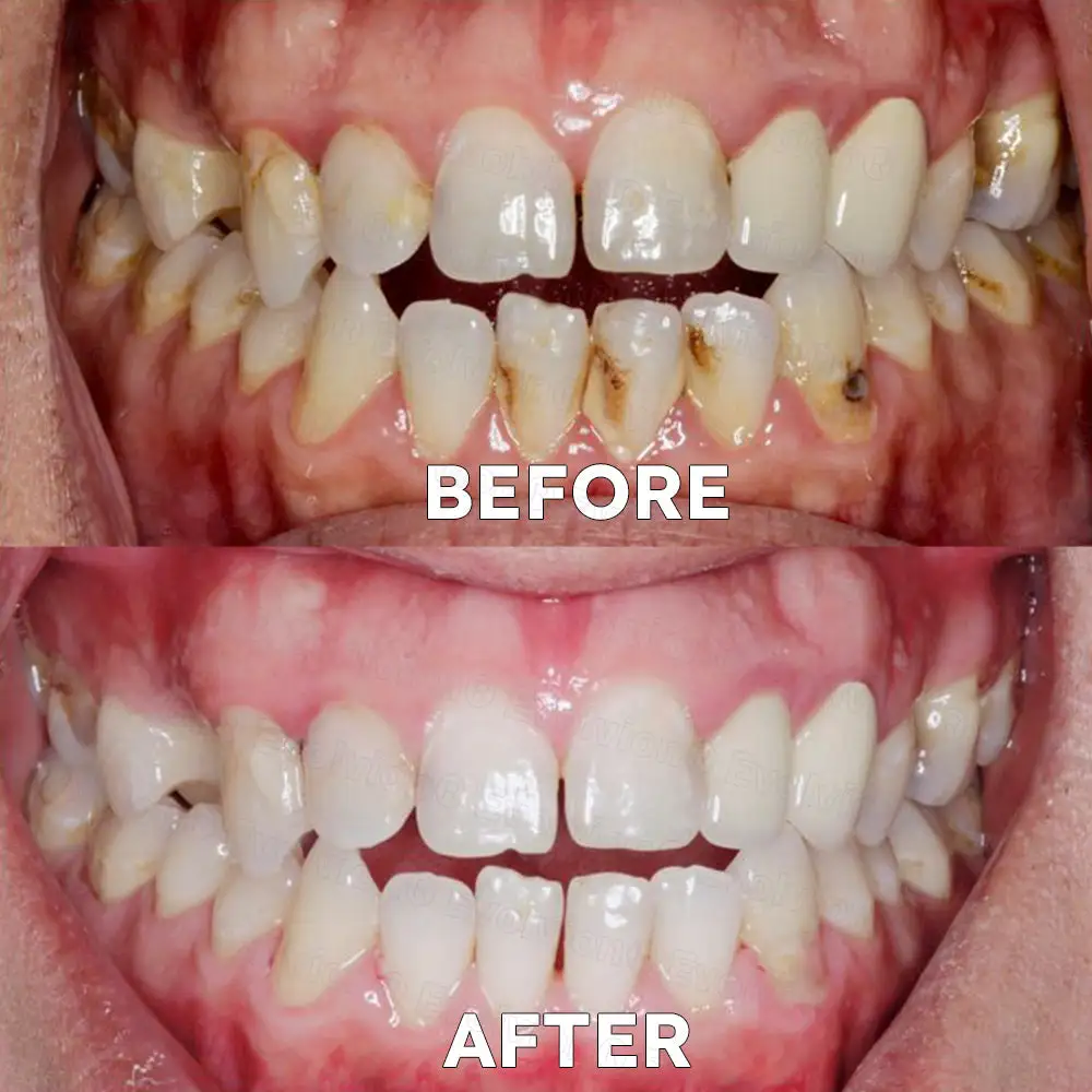 Fluoride-Free Nano Hydroxyapatite Tooth Powder - Image 5