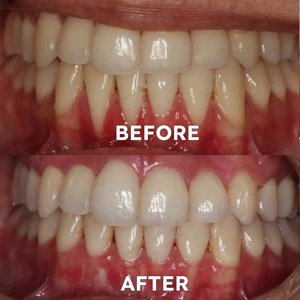 Fluoride-Free Nano Hydroxyapatite Tooth Powder - Image 6