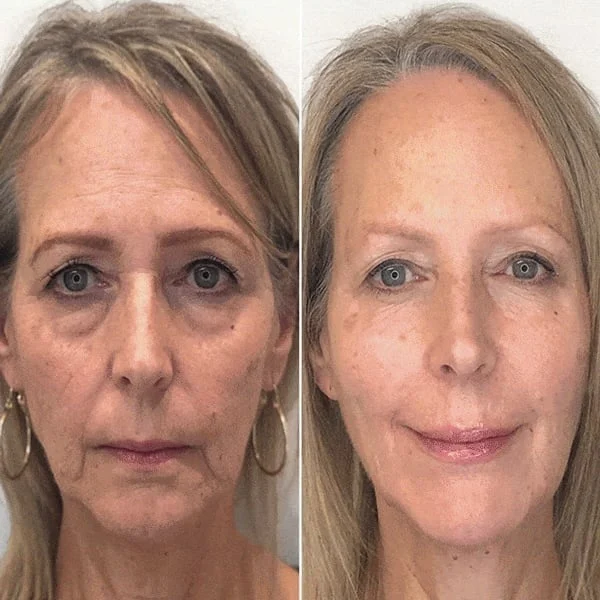 Oveallgo ™ Youthfully Botox Face Serum - Image 4