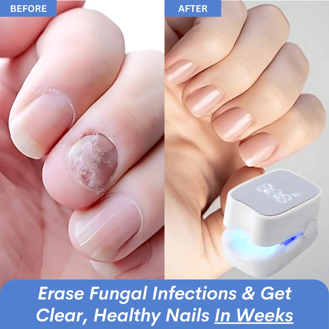 - Nail Fungus Laser Device - Image 7