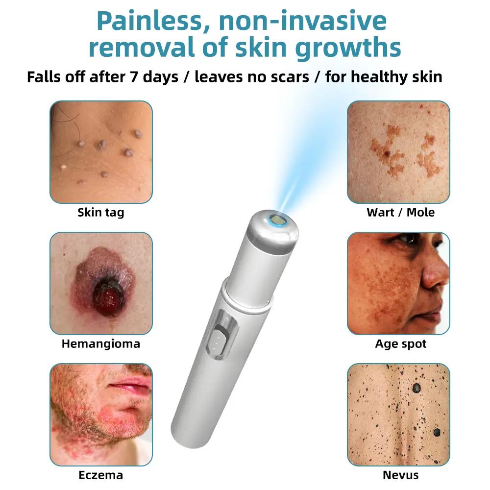 Non-invasive Mole & Wart Removal Laser Pen - Image 2