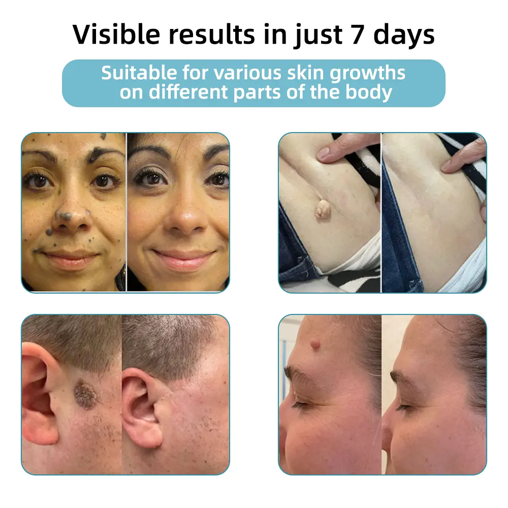 Non-invasive Mole & Wart Removal Laser Pen - Image 3