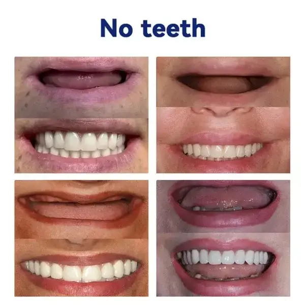 New Generation Flexible Full Denture Solution - Image 5