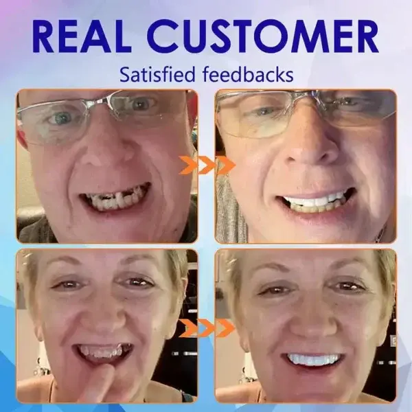 New Generation Flexible Full Denture Solution - Image 8