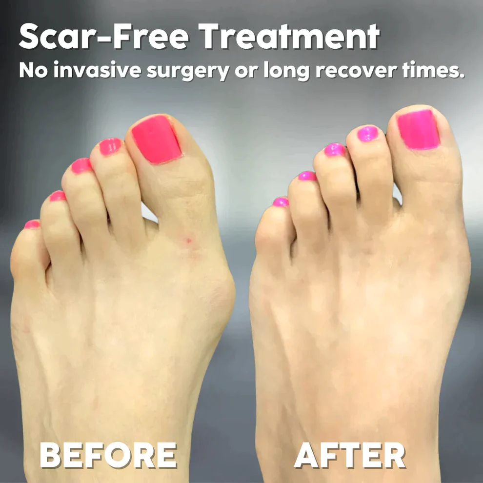 Adjustable Bunion Corrector - Image 6