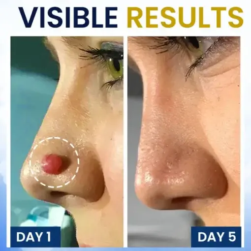 Skin Tag Cryo Treatment Spray Precision Cryo-Tech Freezes Away Skin Tags Warts in Seconds No Blades, No Pain - Image 3
