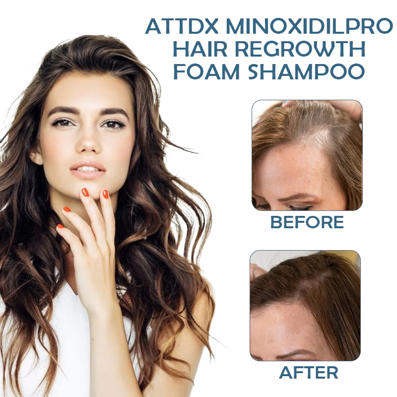 ATTDX MinoxidilPro HairRegrowth FoamShampoo - Image 2