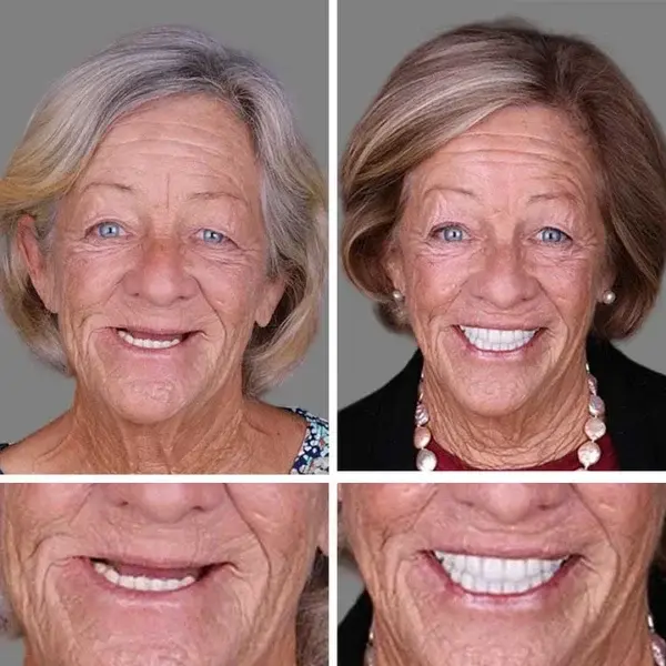 Advanced Customized Full Denture Set - Image 6