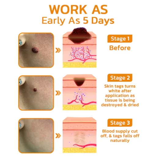 Bee Venom Mole and Wart Treatment Cream - Image 4