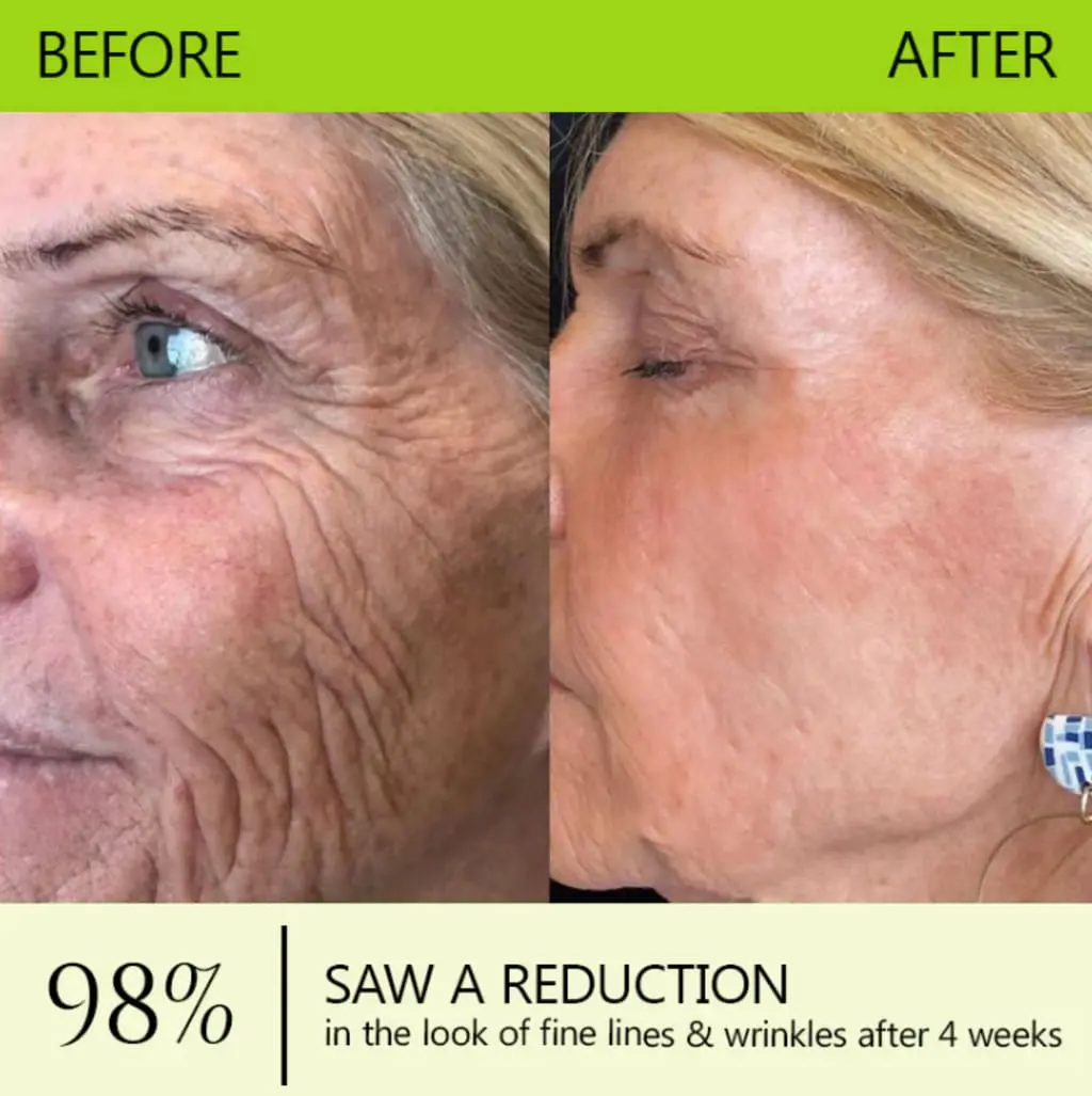 Botox & Retinol Shot - Eraser for deep wrinkles - Image 14